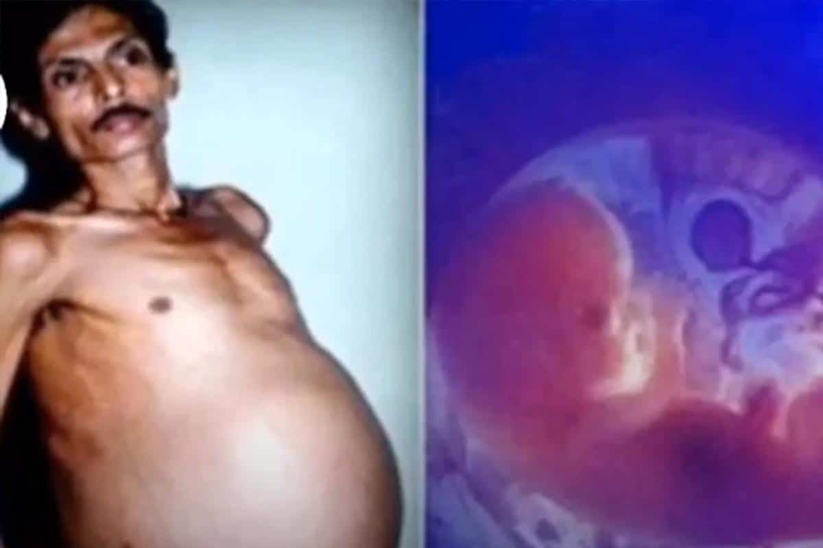 Godinama mu je rastao stomak, a lekari su su njegovom telu našli fetus: Više od 30 godina živeo je sa ta tim u stomaku, a onda je otkriven fenomen